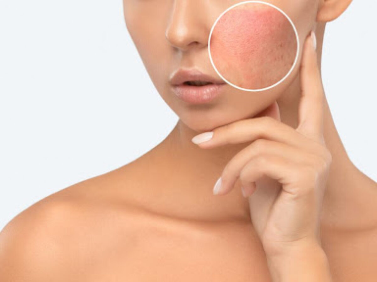 How to Combat Pigmentation on Face: Tips and Treatments