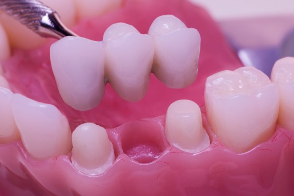 Fixed Dental Bridges