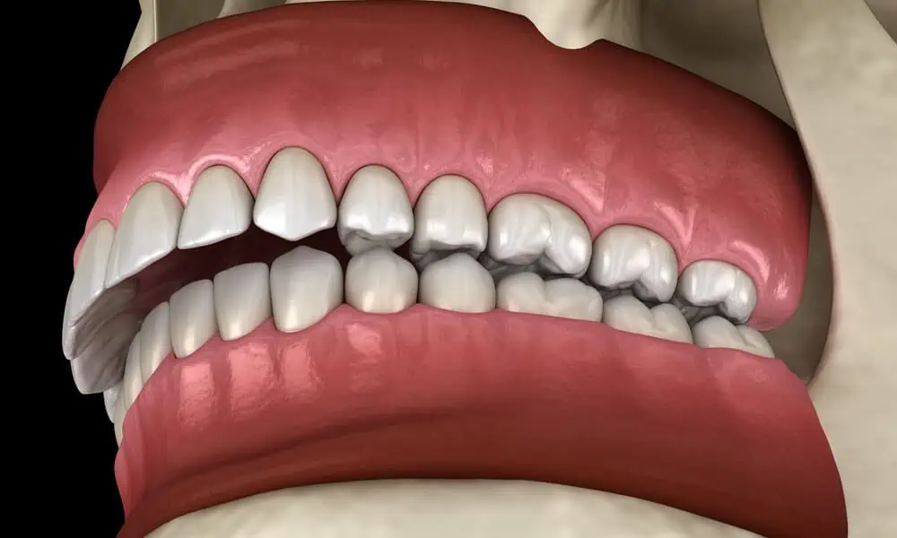 How Invisalign Can Help in Overbite Correction?