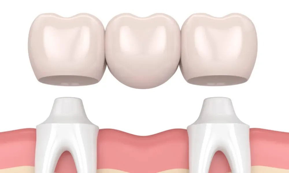 Fixed Dental Bridges: What They Are and How They Work