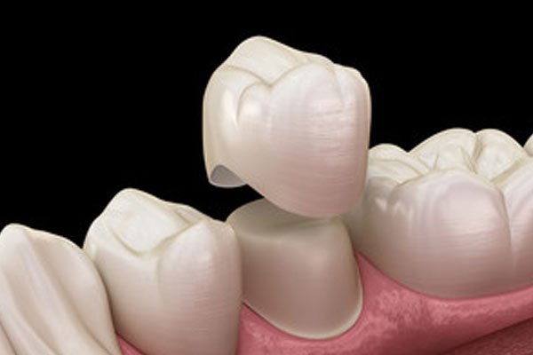 porcelain crowns