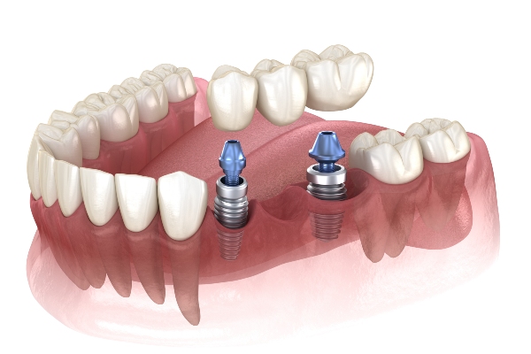 Dental Implants