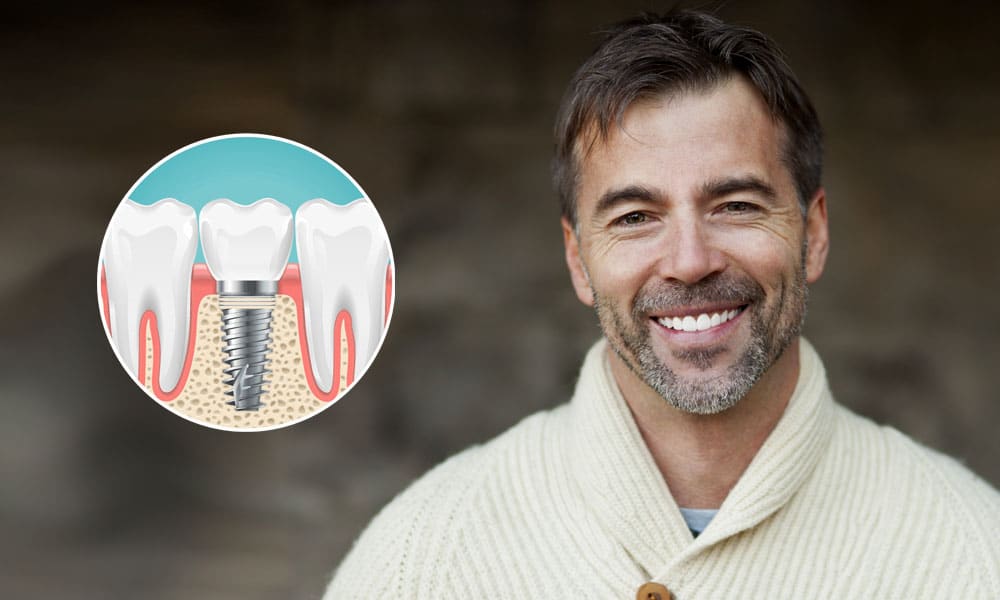 Immediate Dental Implants