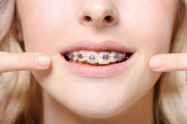 Traditional Braces