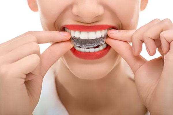 Invisalign for Busy Professionals